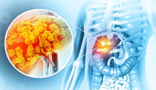 Fatty Liver Reversal