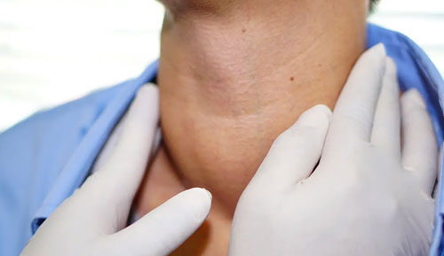 Hyperthyroid